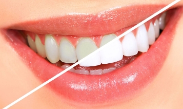 Tanden bleken behandeling - Tandartspraktijk Leidsche Rijn